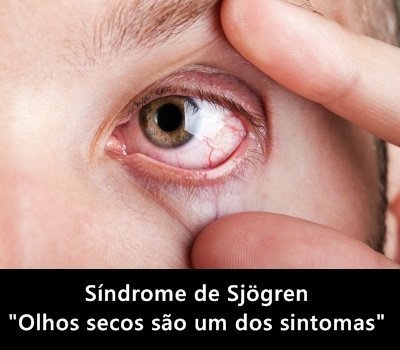 Síndrome de Sjögren (SS)