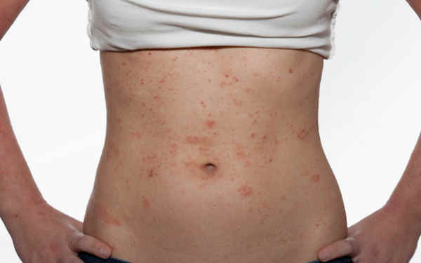 Pesquisa aponta resultados sobre complicações da psoríase em brasileiros