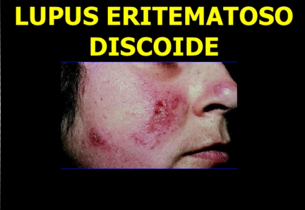 O que é Lupus Eritematoso Crônico Discóide?