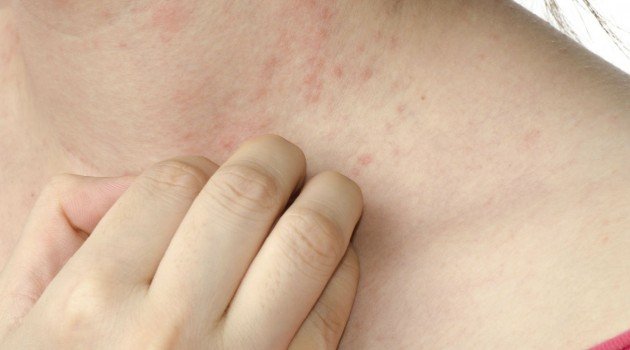 Sociedade Brasileira de Dermatologia chama população para contribuir no protocolo clínico de psoríase