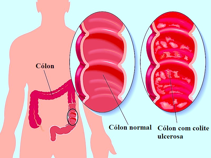 Colite - inflamação intestinal | Dr. Juliano Pimentel