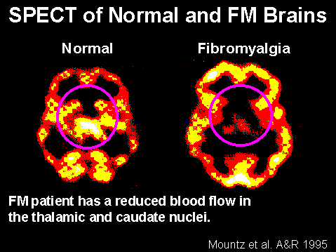 cerebro-fibromialgia
