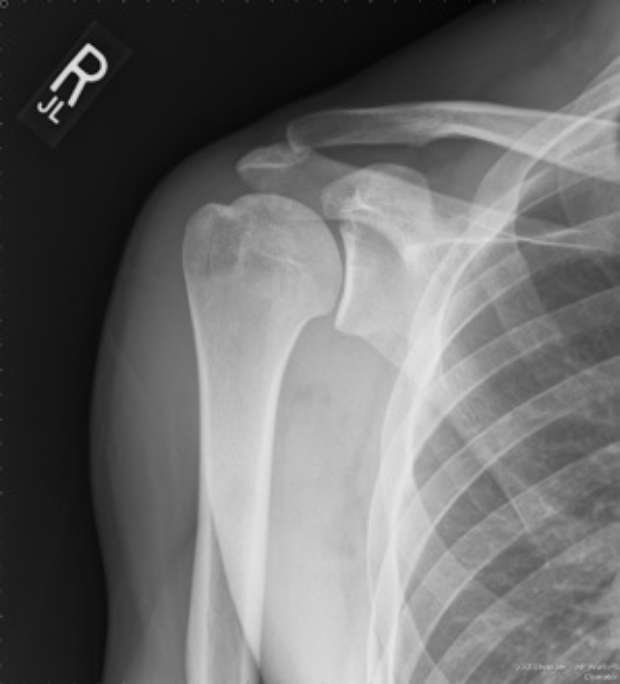 Dados recentes revelam que artrose do ombro é comum