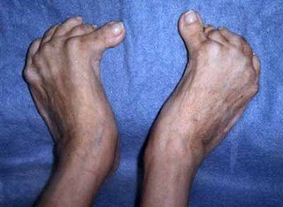 Doença de Paget – Osteíte deformante: Diagnóstico e tratamento