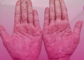 O que é a artrite psoriásica?