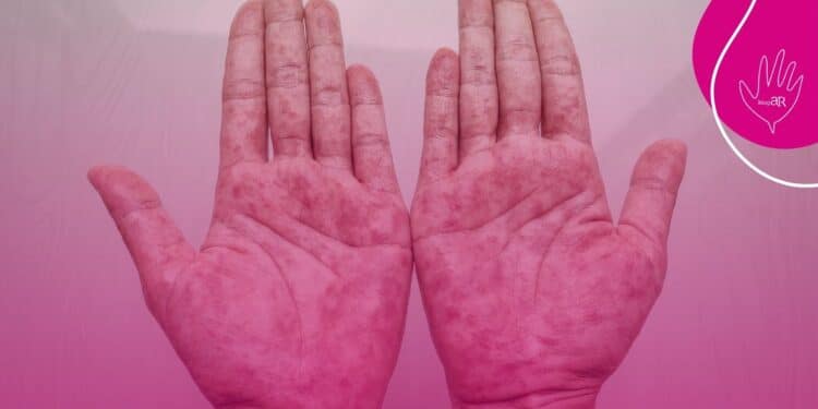 O que é a artrite psoriásica?