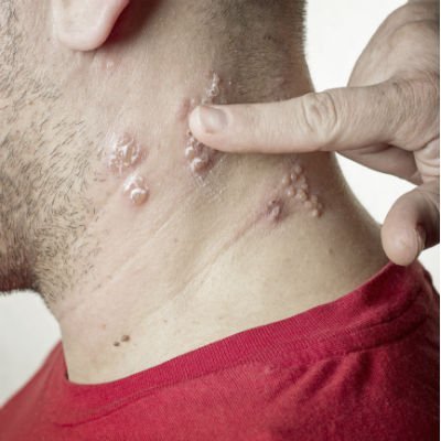 Dor após infeção por herpes-zóster: O que pode ser?