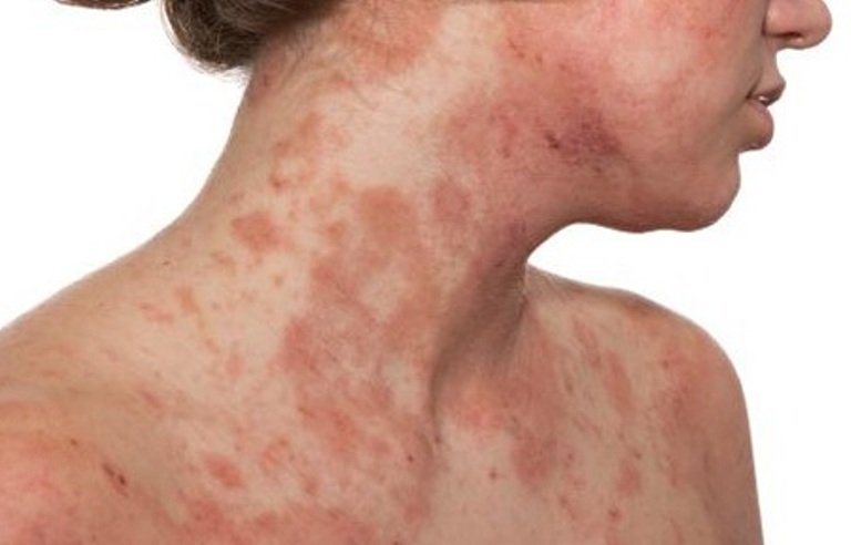 FDA Classifica inibidor seletivo da JAK1, da AbbVie, como terapia inovadora para dermatite atópica