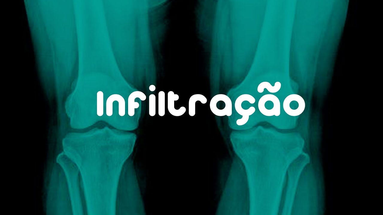 Saiba Mais Sobre Infiltração