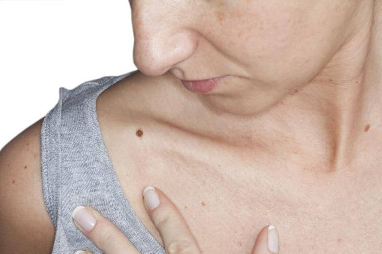 O câncer de pele pode ser interrompido com drogas para tratamento da artrite