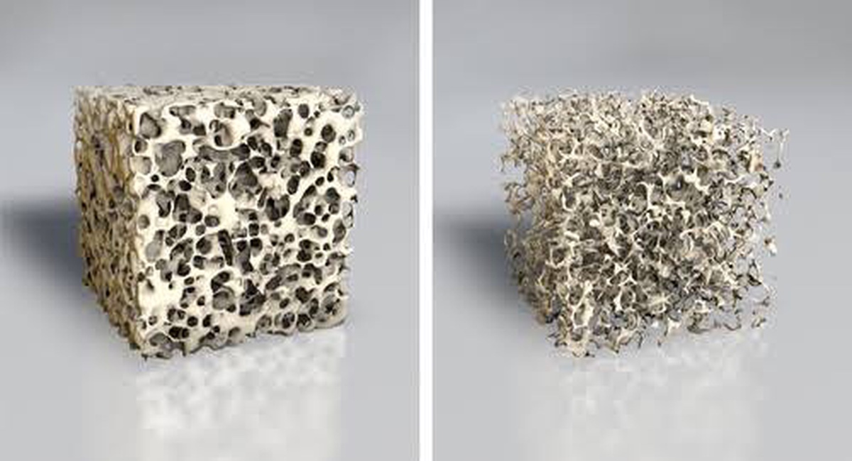 Atlas da Osteoporose mostra fatores genéticos ligados  doença