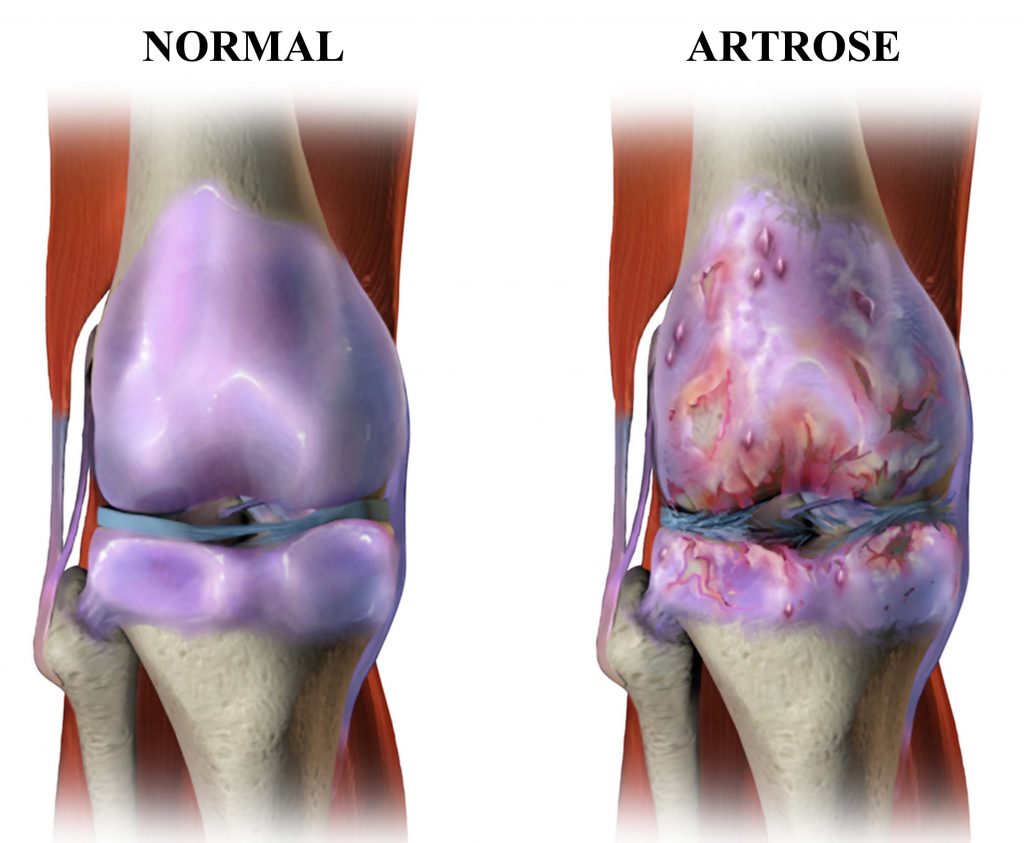 Osteoartrite de joelho: qual melhor tratamento para dor a longo prazo?