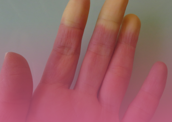 Esclerose Sistêmica