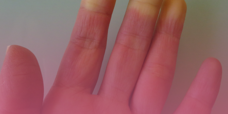 Esclerose Sistêmica