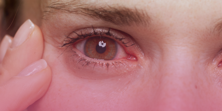 Síndrome de Sjögren