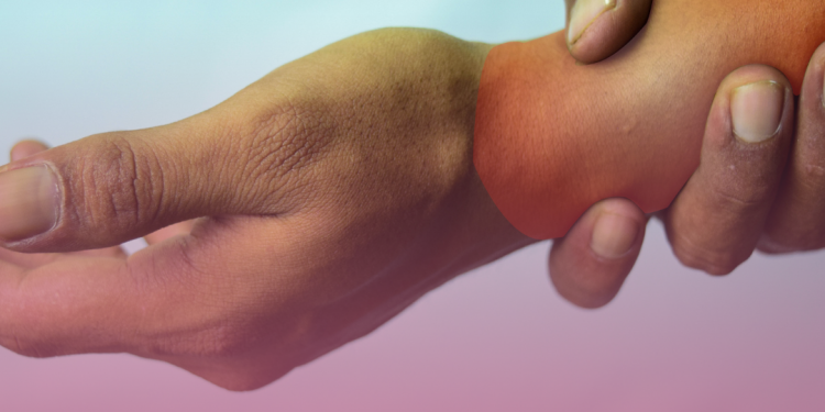 Lesão por Esforço Repetitivo (LER/DORT)