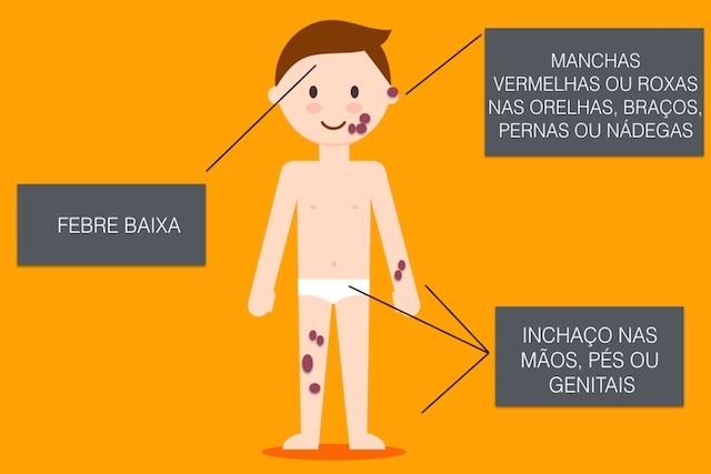 5 dicas preciosas para evitar a Vasculite