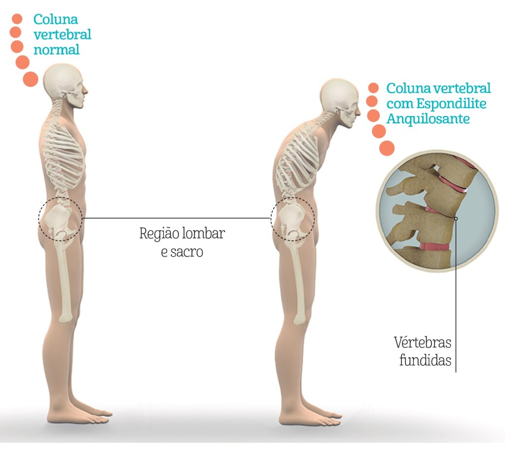 Atividade física: Dor lombar e Espondilite Anquilosante