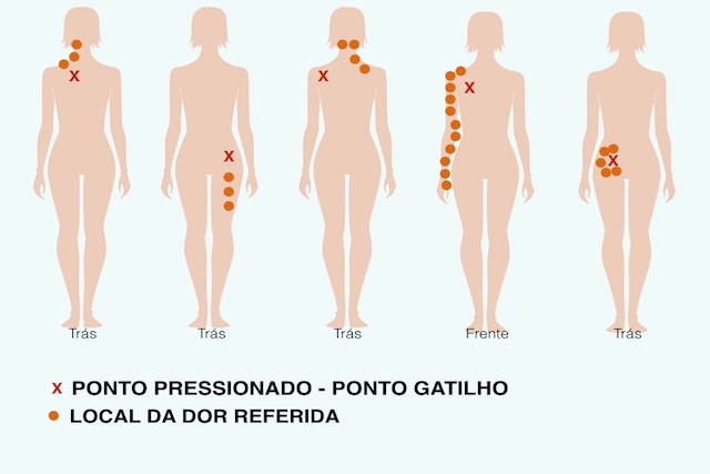Fibromialgia ou dor miofascial?