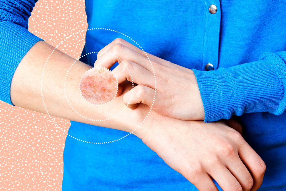 Psoríase: uma pele sem lesão é possível