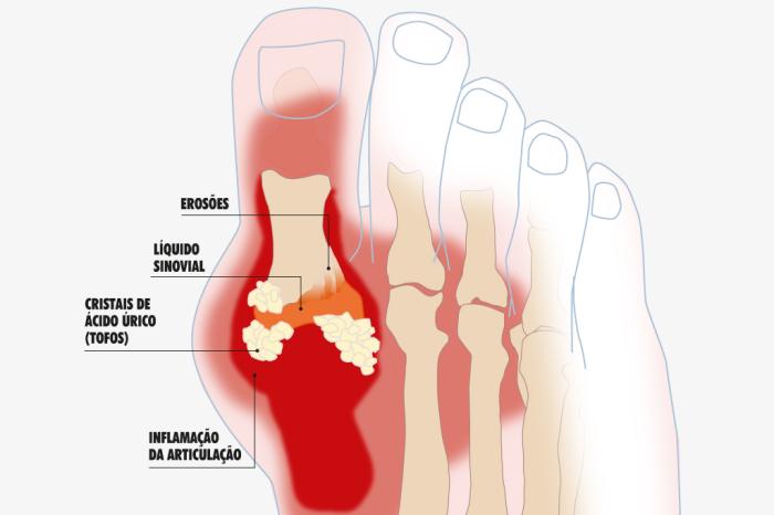 Uma doença chamada gota
