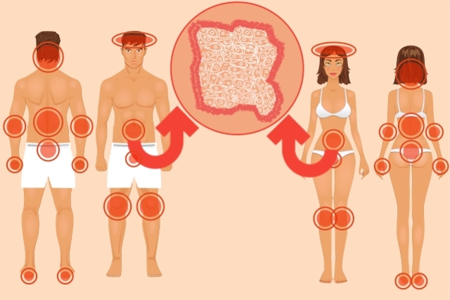 O que é a psoríase?