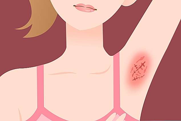 Pacientes de Hidradenite Supurativa têm nova opção de tratamento com a incorporação de Humira (adalimumabe) pelo SUS