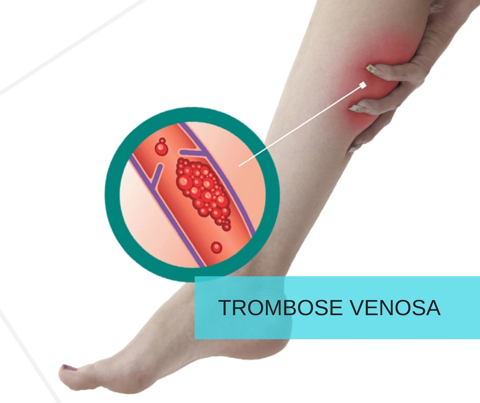 Trombose venosa e viagens aéreas de longa distância