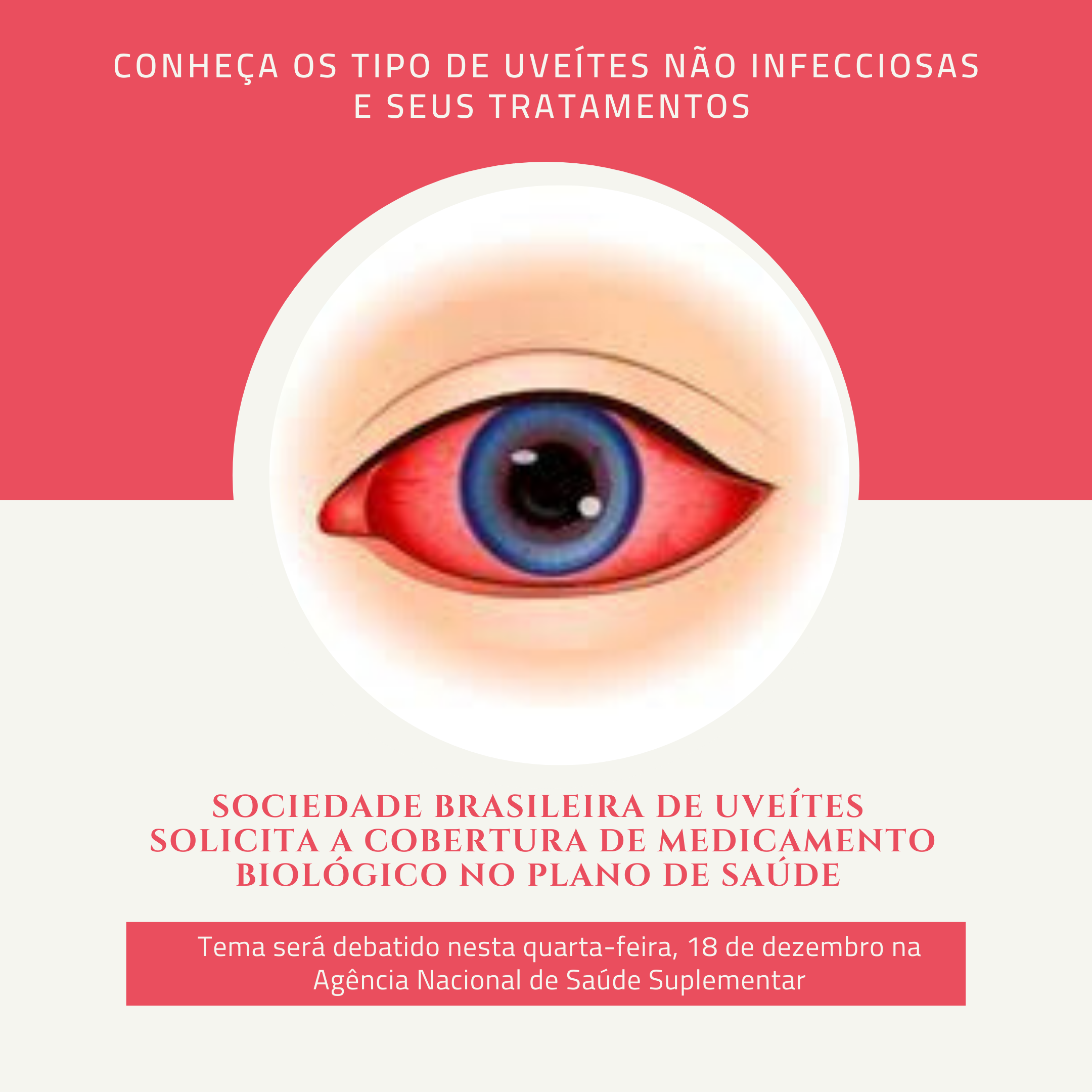 Uveítes não Infecciosas podem ter graves consequências se não tratadas adequadamente