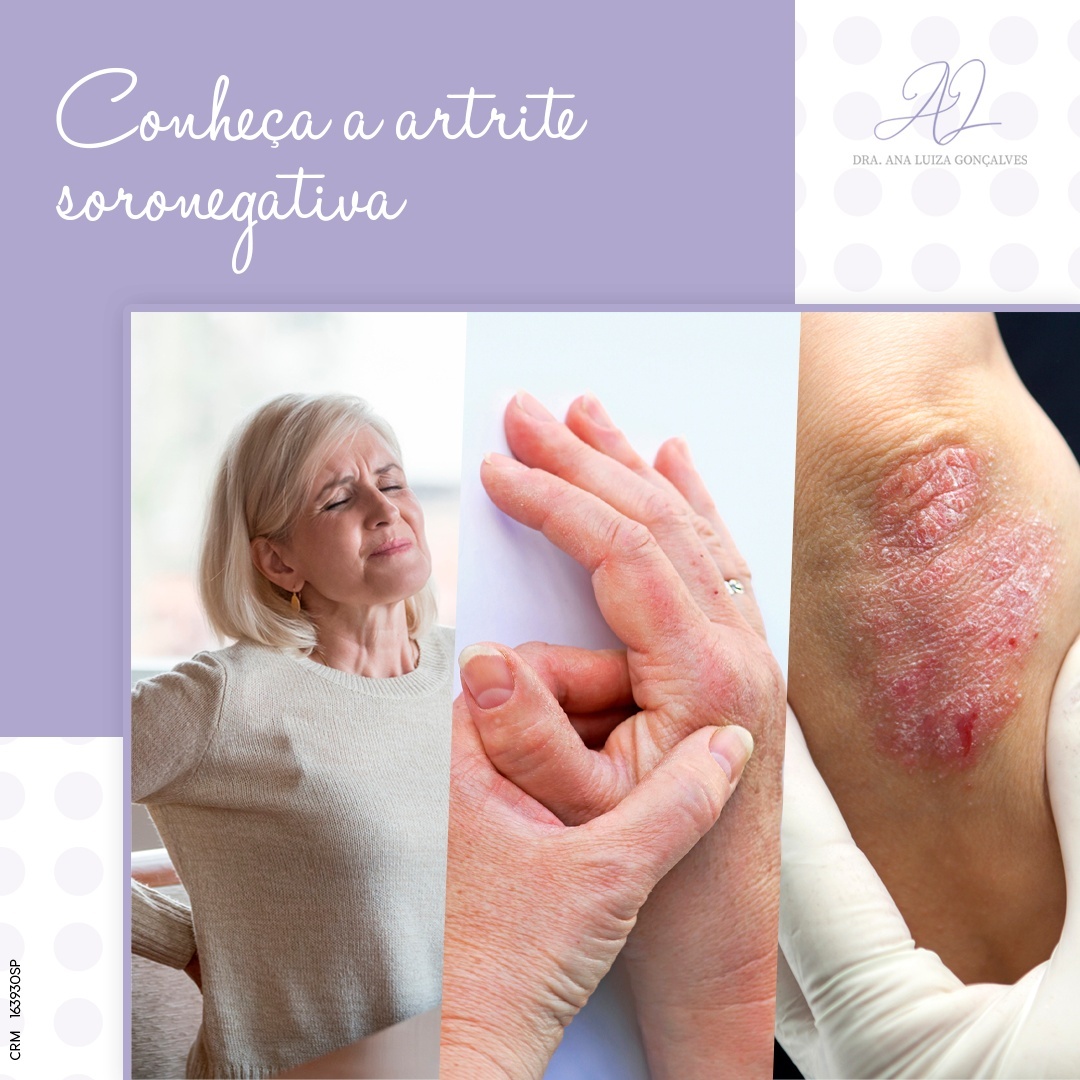 Conheça a artrite soronegativa