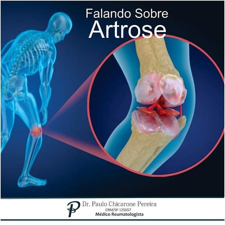 Falando sobre artrose