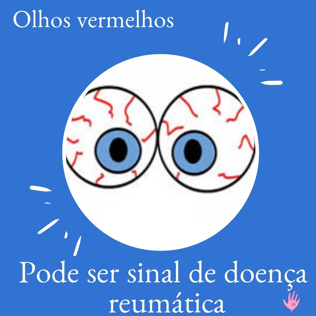 Olhos vermelhos podem indicar artrite idiopática juvenil?
