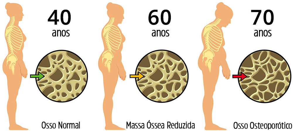 Osteoporose: ameaça à saúde da mulher
