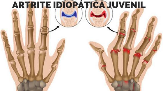 artrite cronica juvenil)