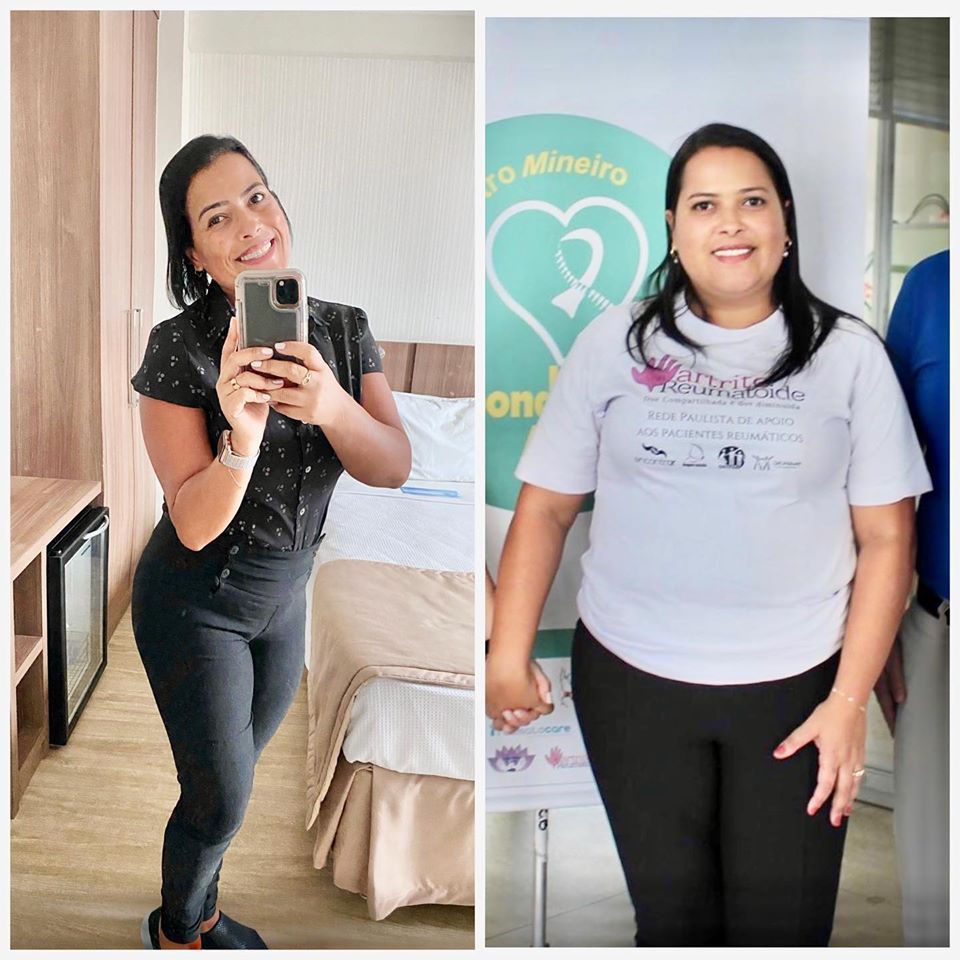 Sorriso da gratidão de quem venceu a obesidade e colocou a artrite reumatoide para dormir!