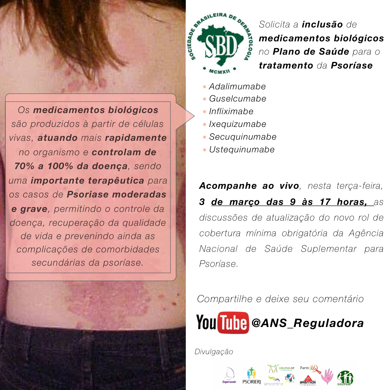 Sociedade Brasileira de Dermatologia solicita para a Agência Nacional de Saúde Suplementar à inclusão de novos tratamentos fornecidos pelos Planos de Saúde para o tratamento da Psoríase