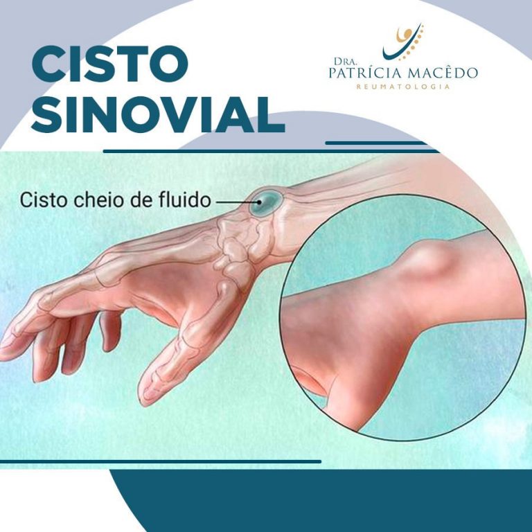 Cisto Sinovial – Artrite Reumatoide