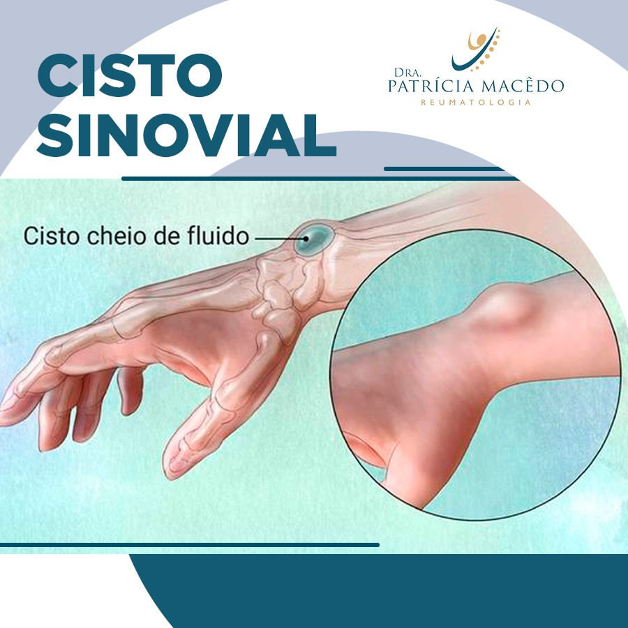 Cisto Sinovial