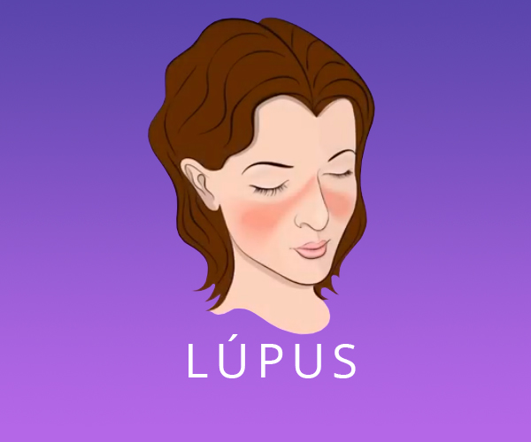 Lúpus – Especialista esclarece dúvidas sobre a doença