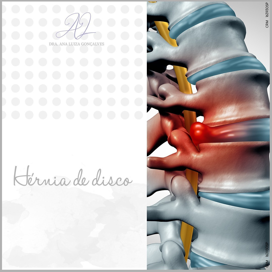 Hérnia de disco