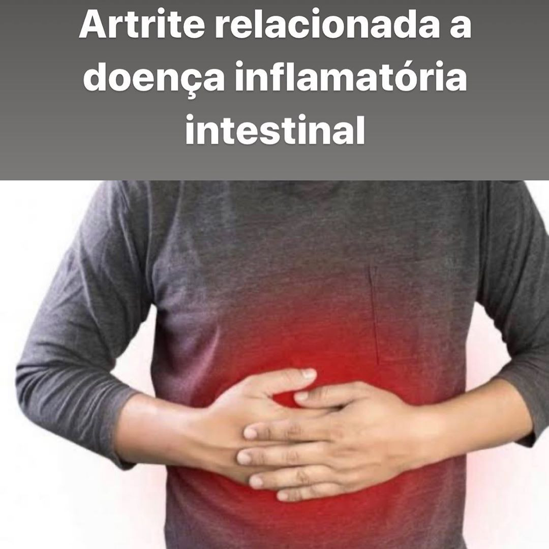 Artrite relacionada a doença inflamatória intestinal (DII)