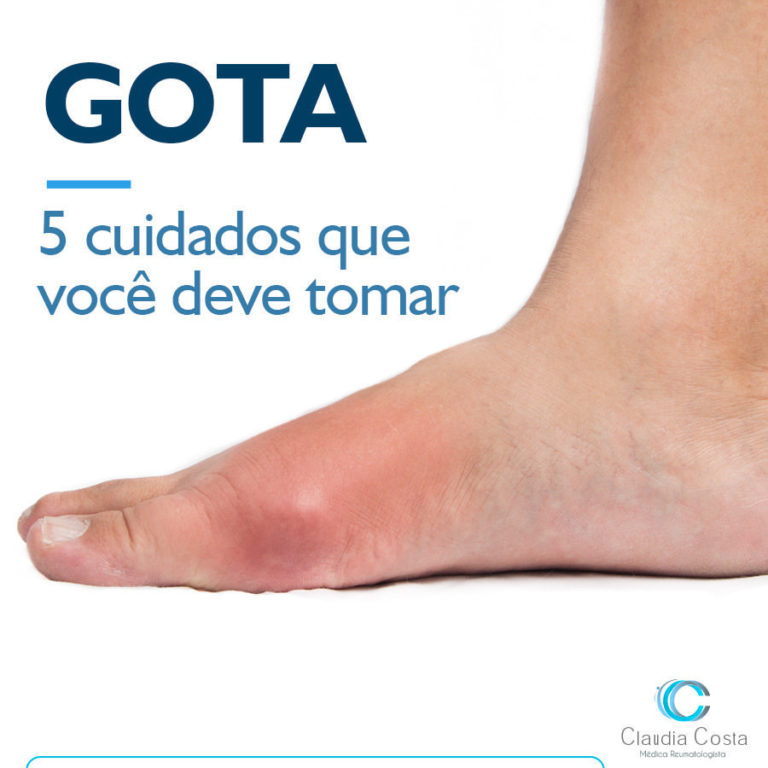 Gota 5 cuidados que você deve tomar Artrite Reumatoide