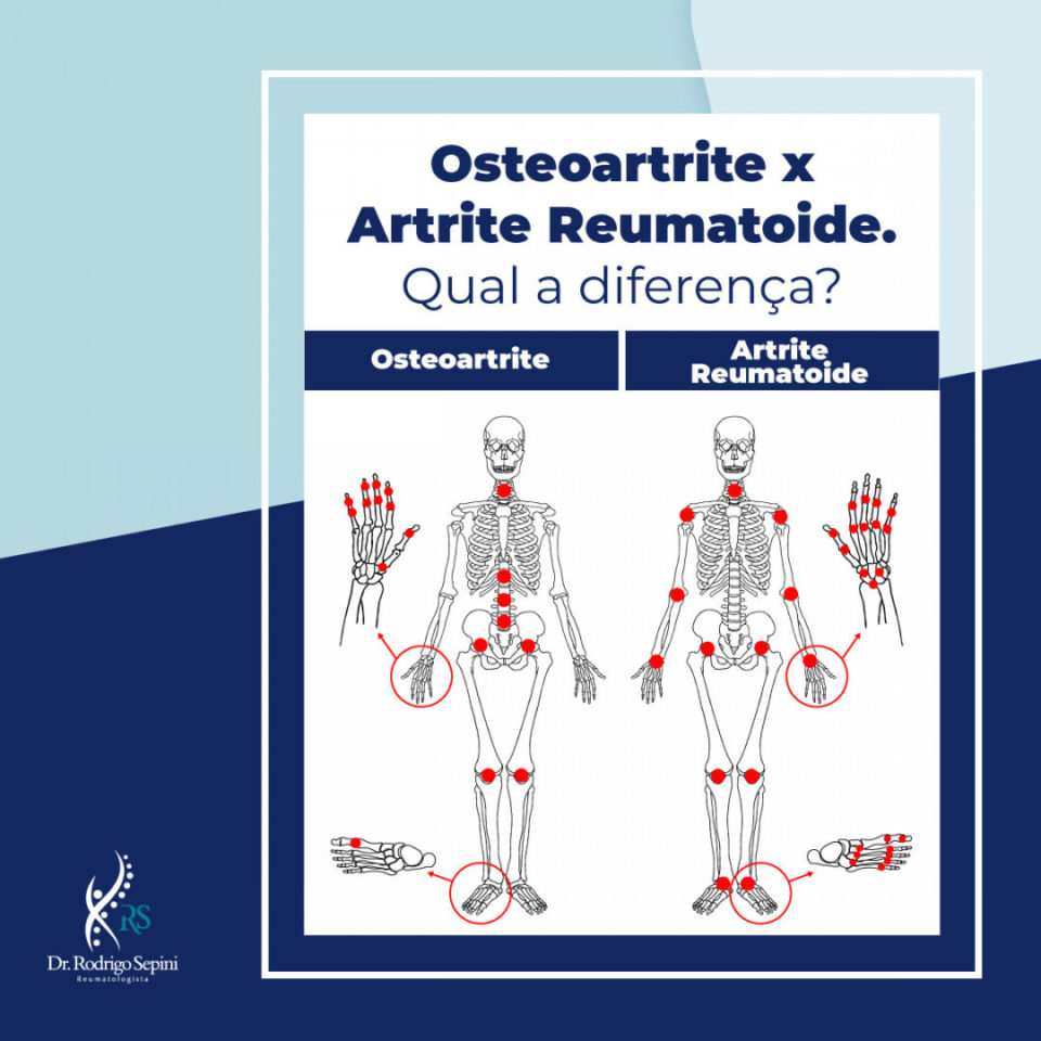 Osteoartrite X Artrite Reumatoide Qual A Diferen A Artrite Reumatoide