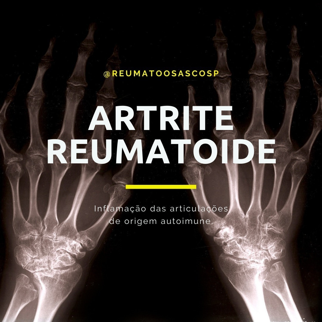 Artrite Reumatoide – Inflamação das articulações de origem autoimune