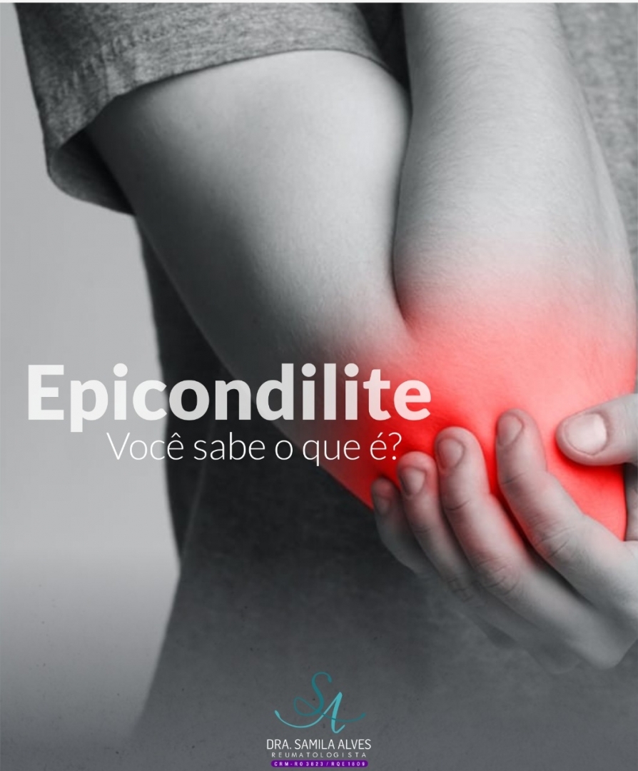 Epicondilite – Você sabe o que é?