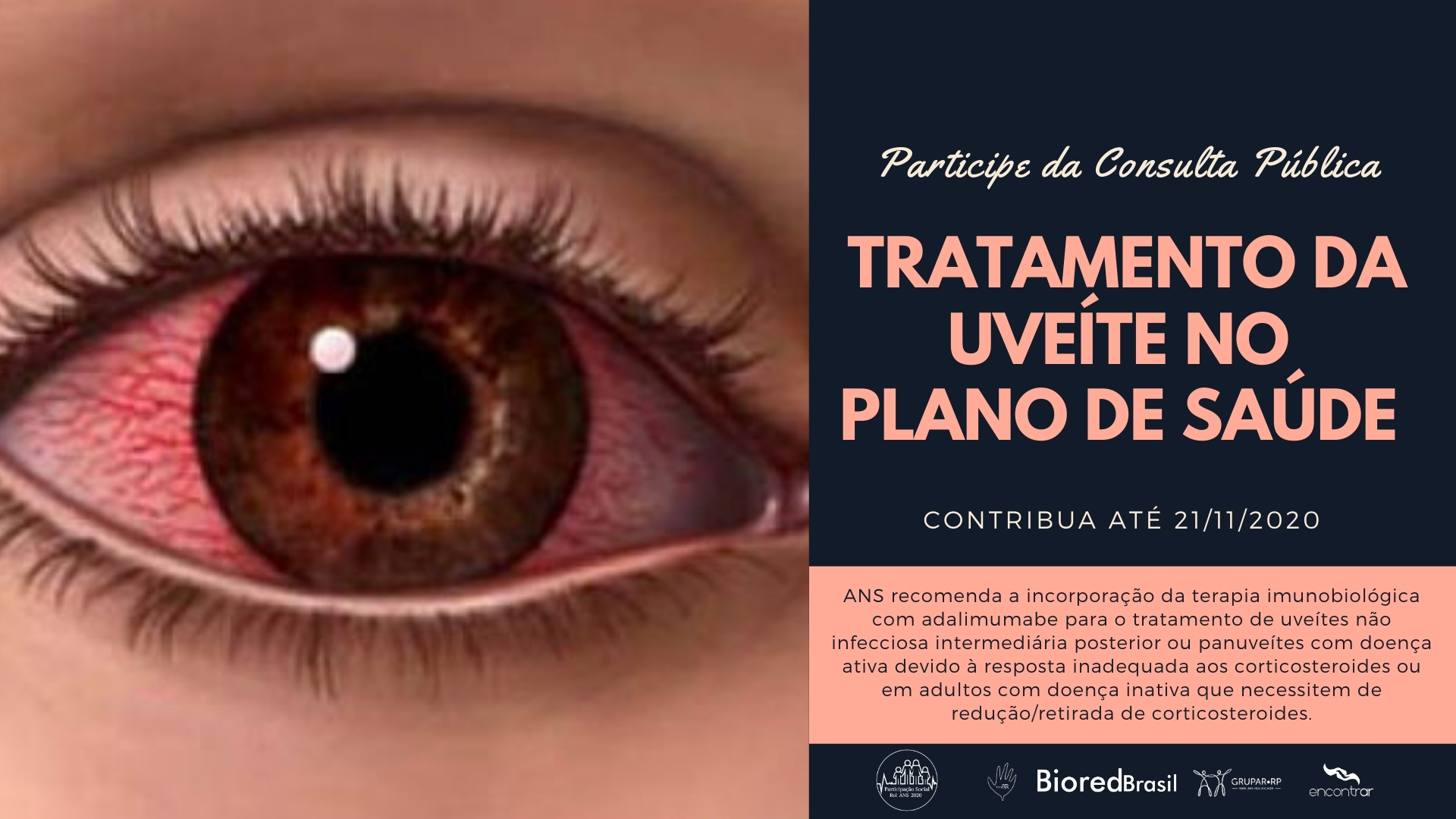 Inclusão de um novo tratamento para uveítes no plano de saúde, é tema da consulta pública nº 81 da ANS 