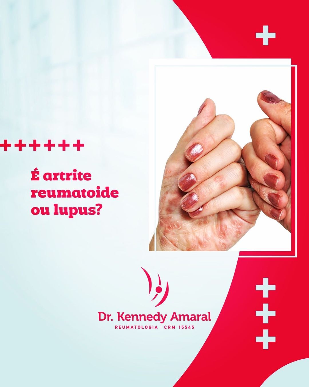 É artrite reumatoide ou lúpus