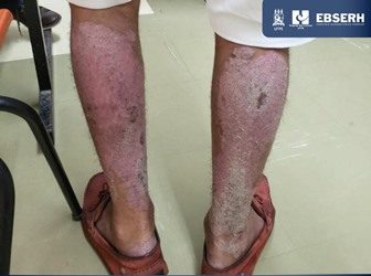 Em estudo, médicos do HC validam questionário internacional de rastreio da artrite psoriásica