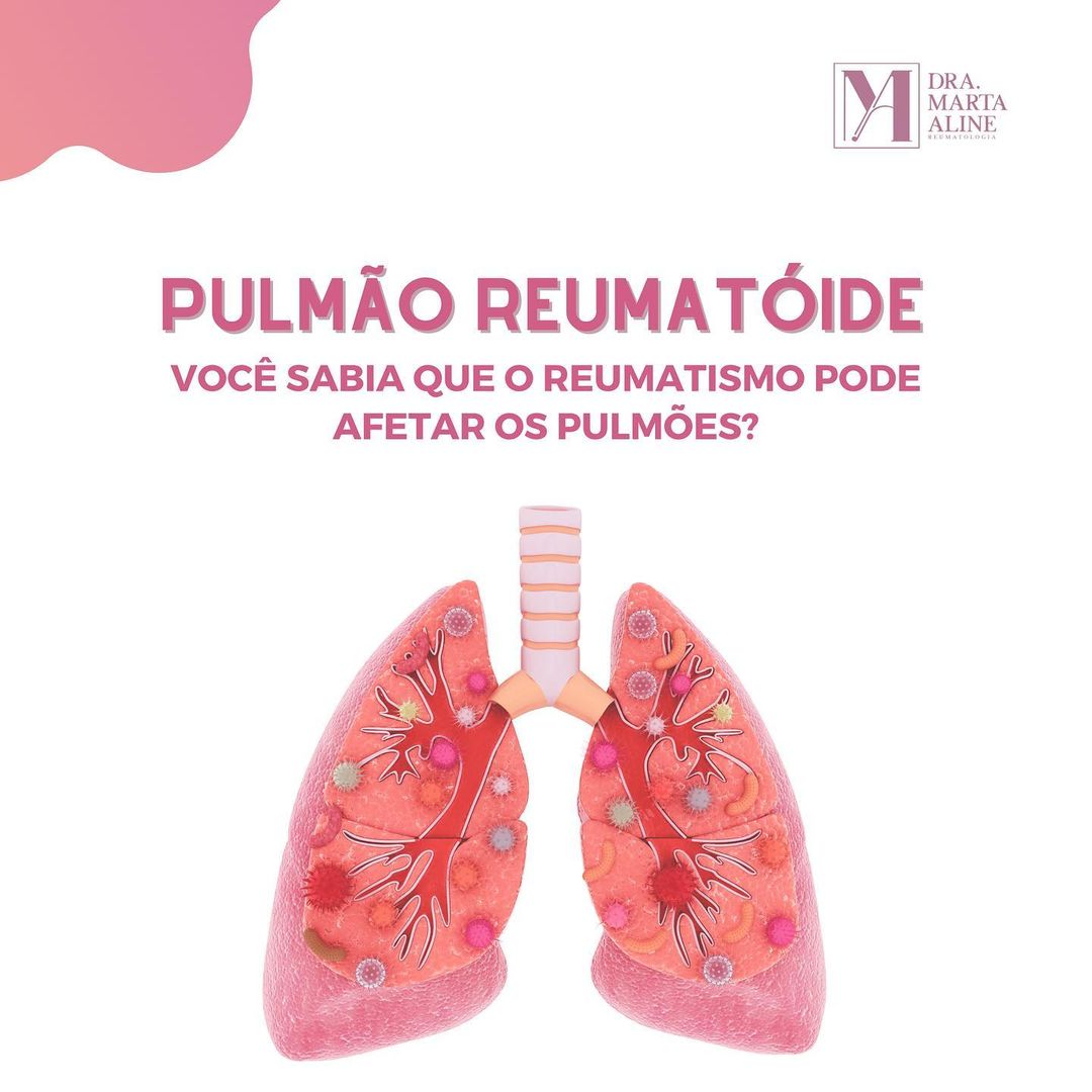 Pulmão reumatoide – Você sabia que o reumatismo pode afetar os pulmões?