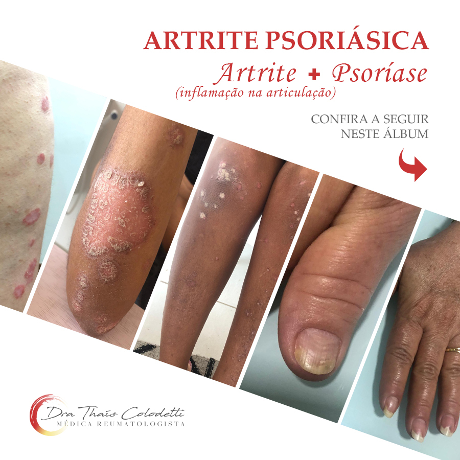 Entenda a Artrite Psoriásica
